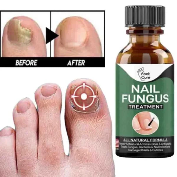 Fast Nail Fungal Treatments Nail Repair Serum Treats Foot Nail Fungus